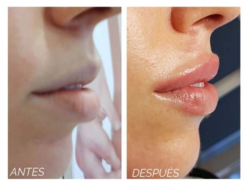 Aumento de Labios